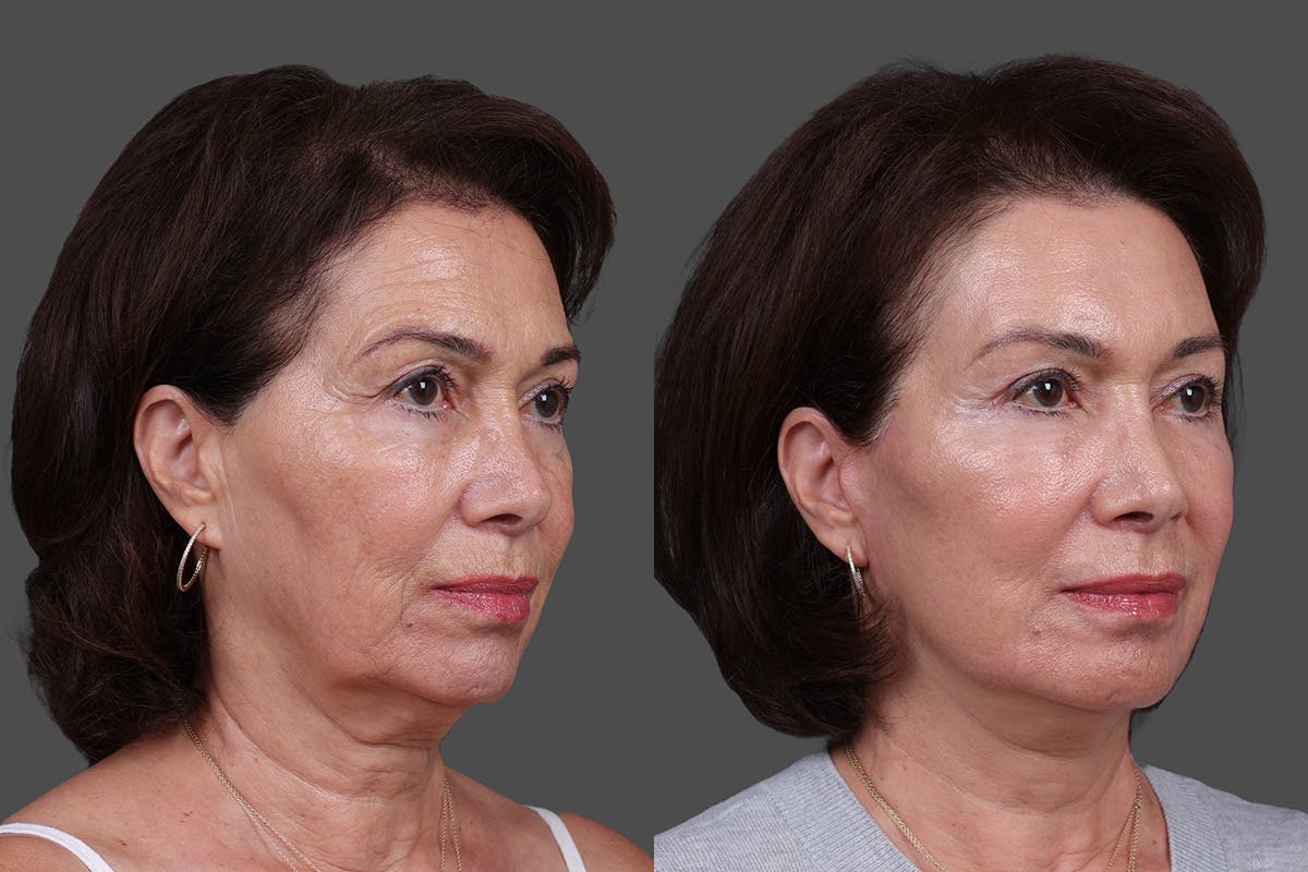 Facial Fat Transfer Before & After Gallery - Patient 446030 - Image 2