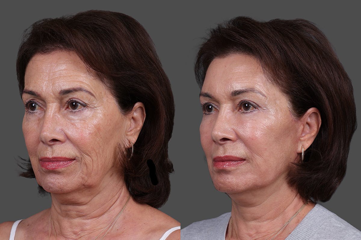 Facial Fat Transfer Before & After Gallery - Patient 446030 - Image 4