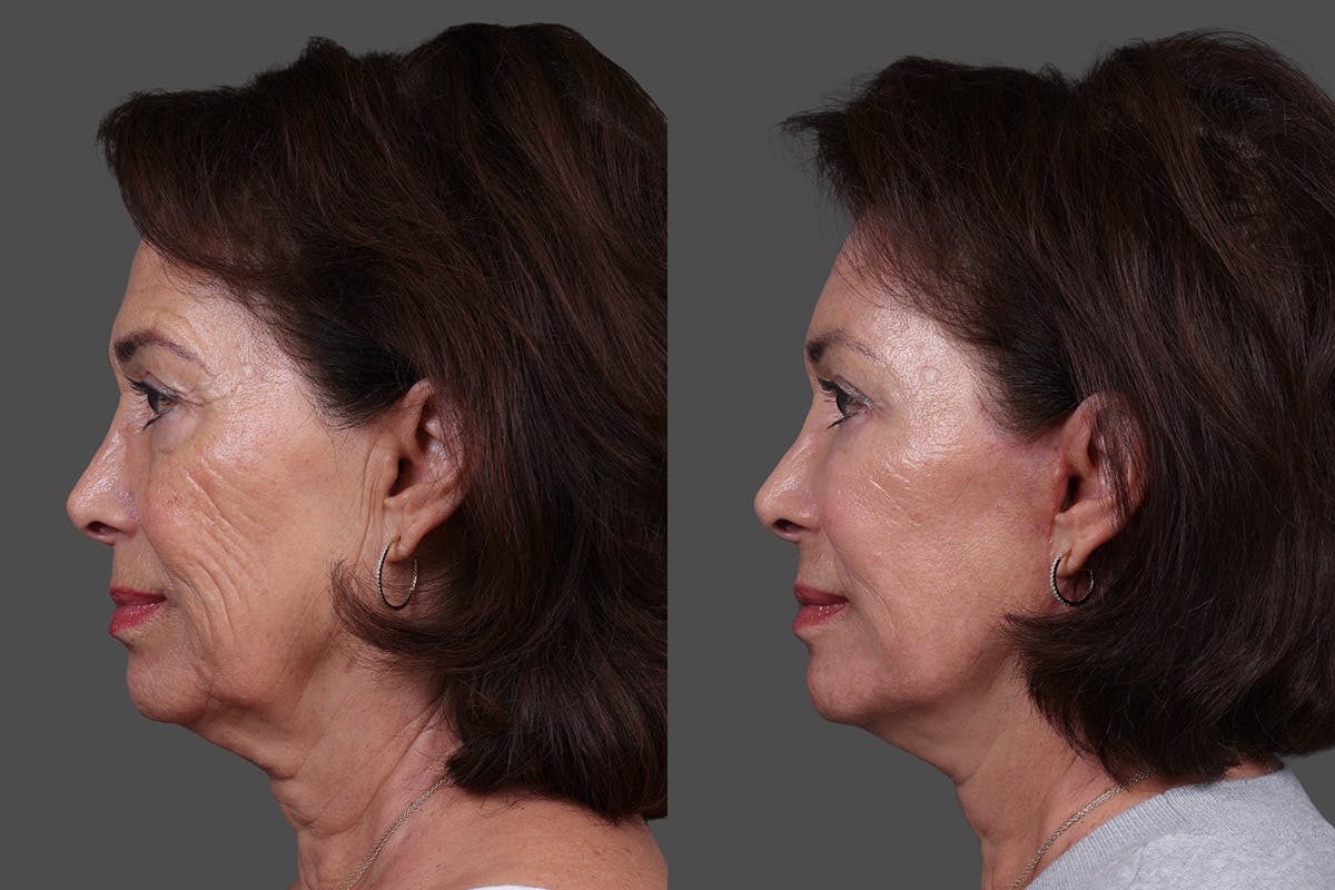 Facial Fat Transfer Before & After Gallery - Patient 446030 - Image 5