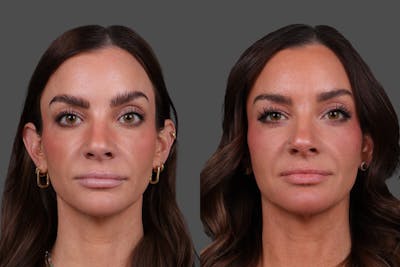 Restylane Before & After Gallery - Patient 988618 - Image 1