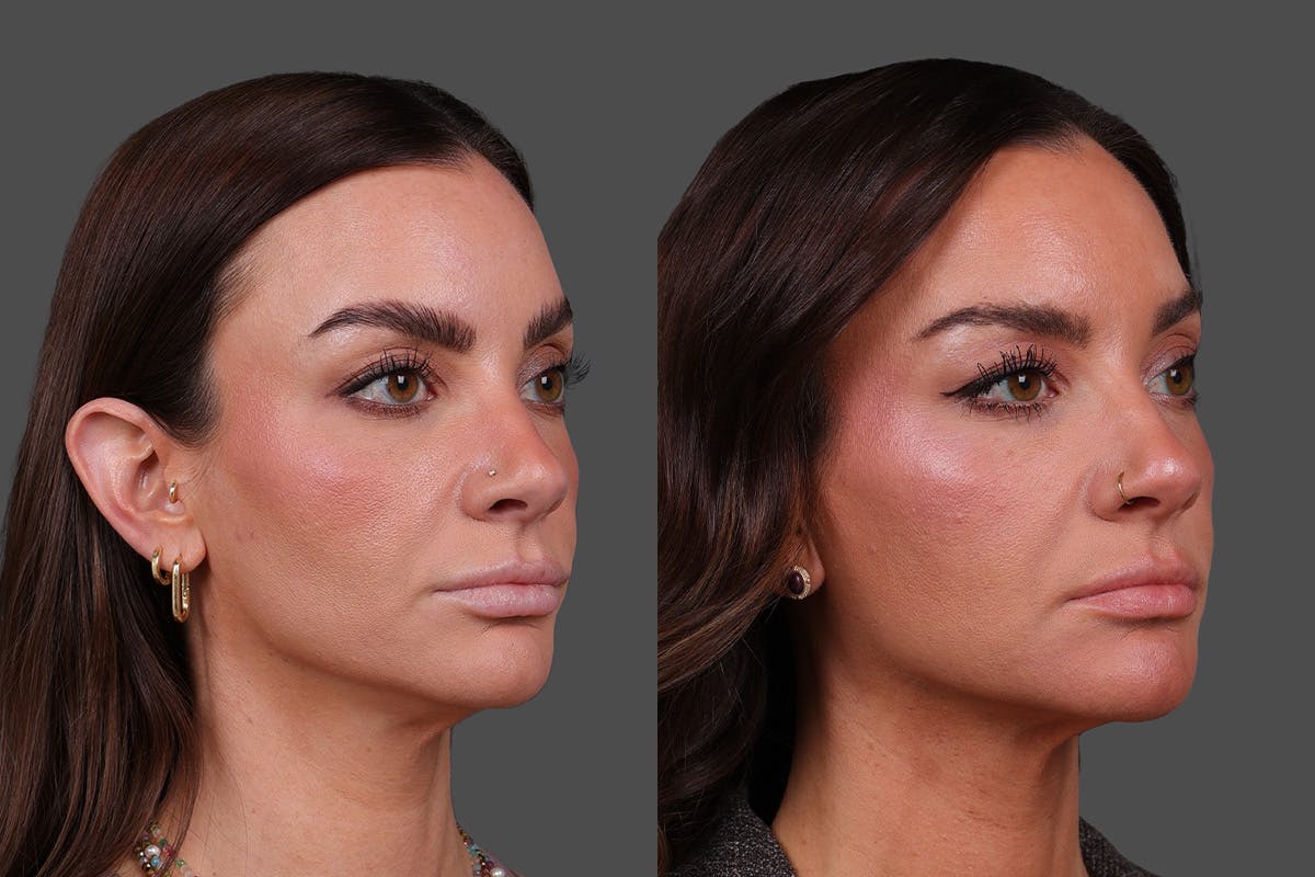 Restylane Before & After Gallery - Patient 988618 - Image 2