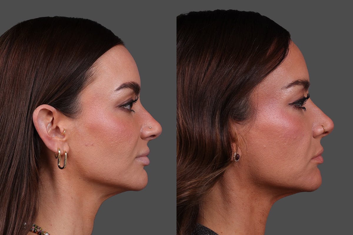 Restylane Before & After Gallery - Patient 988618 - Image 3