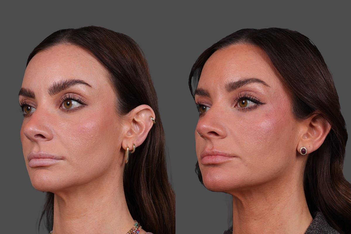 Restylane Before & After Gallery - Patient 988618 - Image 4
