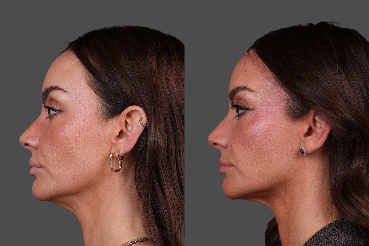 Restylane Before & After Gallery - Patient 988618 - Image 5