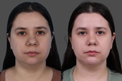 CO2 Fractional Laser Before & After Gallery - Patient 292499 - Image 1