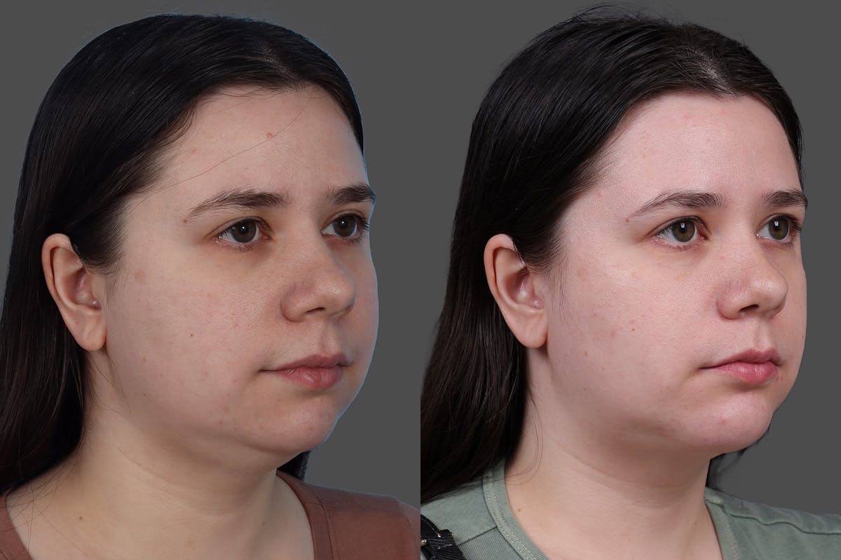CO2 Fractional Laser Before & After Gallery - Patient 292499 - Image 2