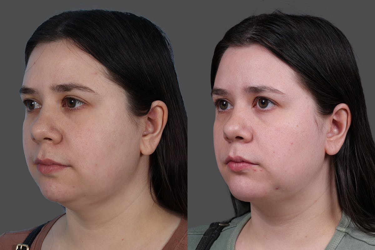 CO2 Fractional Laser Before & After Gallery - Patient 292499 - Image 4