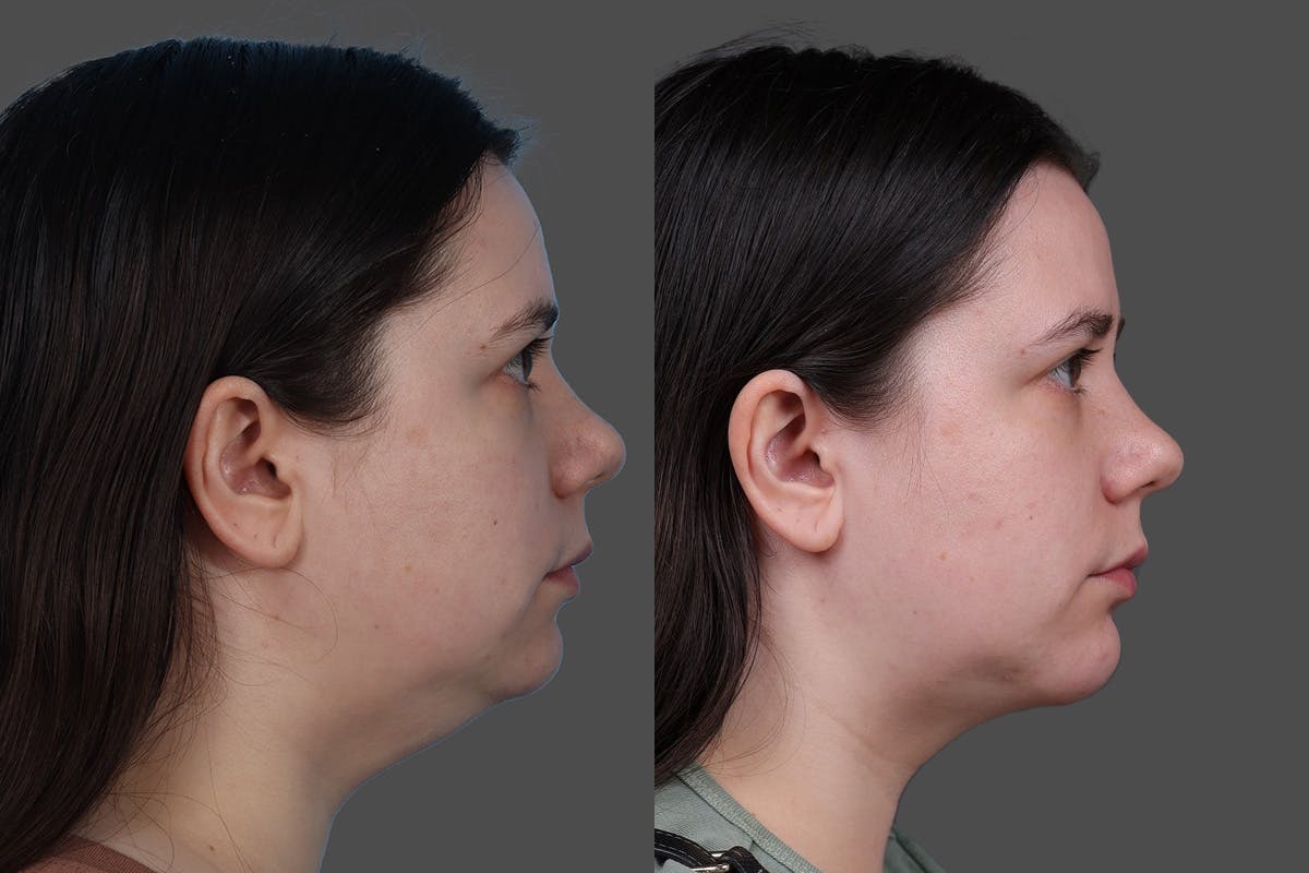 CO2 Fractional Laser Before & After Gallery - Patient 292499 - Image 3
