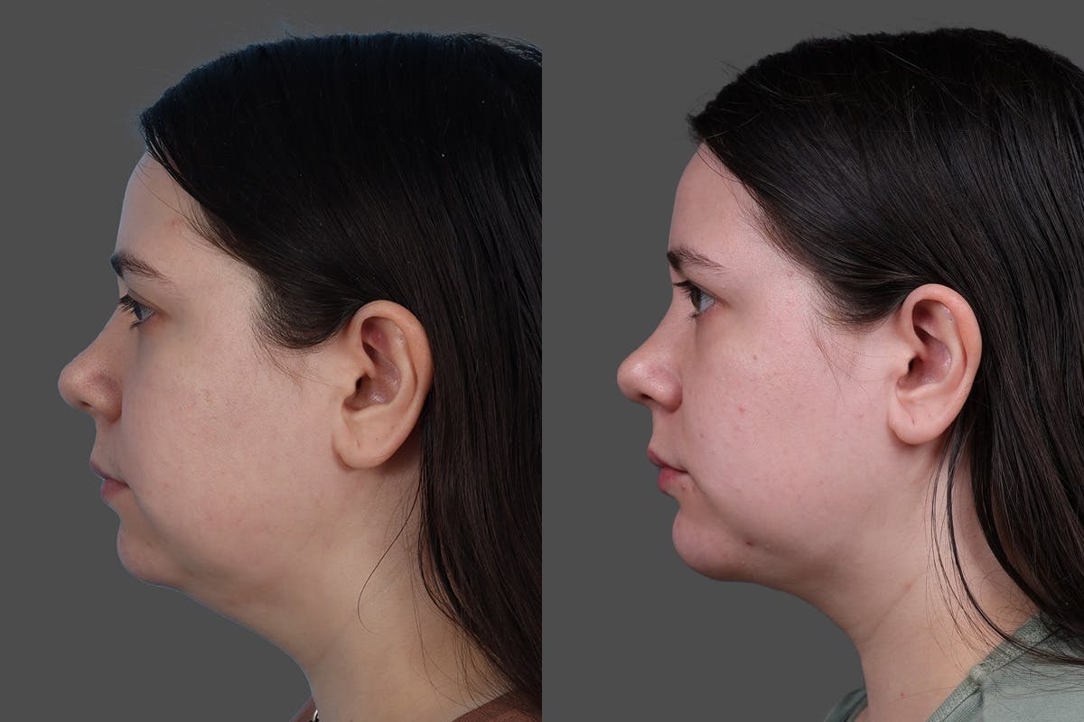 CO2 Fractional Laser Before & After Gallery - Patient 292499 - Image 5