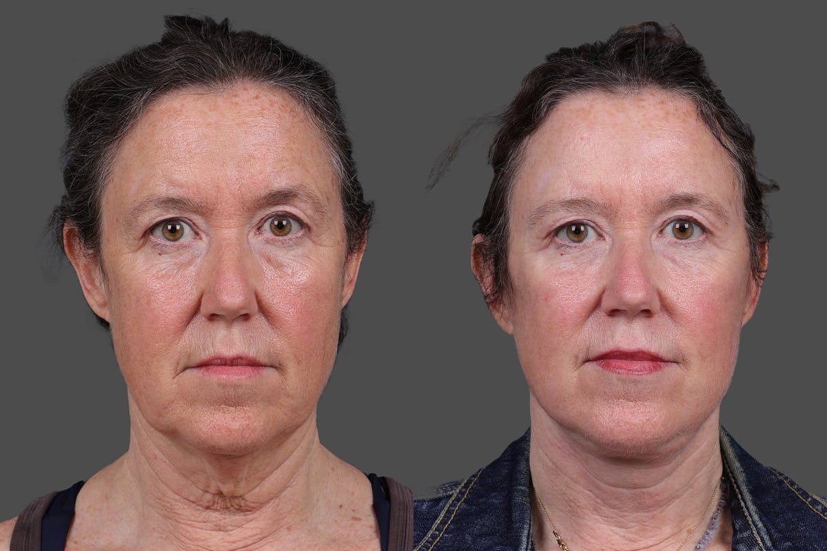Facelift Before & After Gallery - Patient 549528 - Image 1