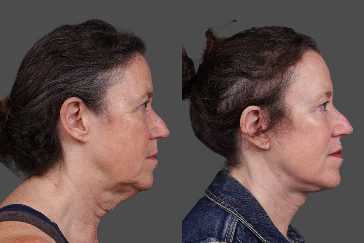 Facelift Before & After Gallery - Patient 549528 - Image 3