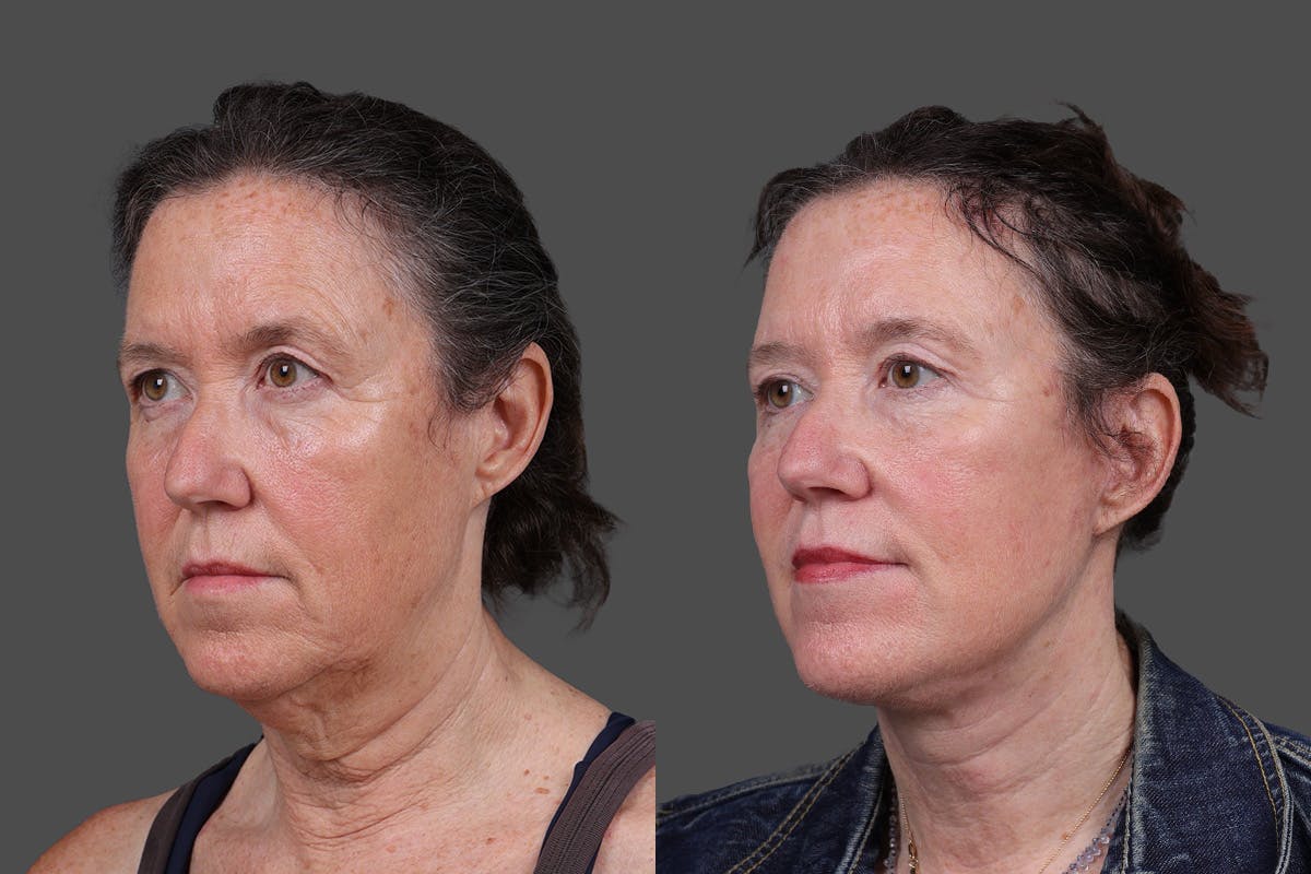Facelift Before & After Gallery - Patient 549528 - Image 4