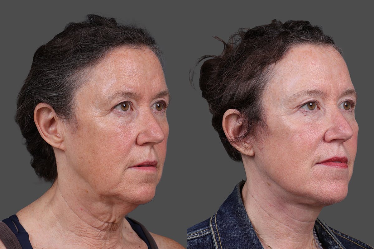 Facelift Before & After Gallery - Patient 549528 - Image 2
