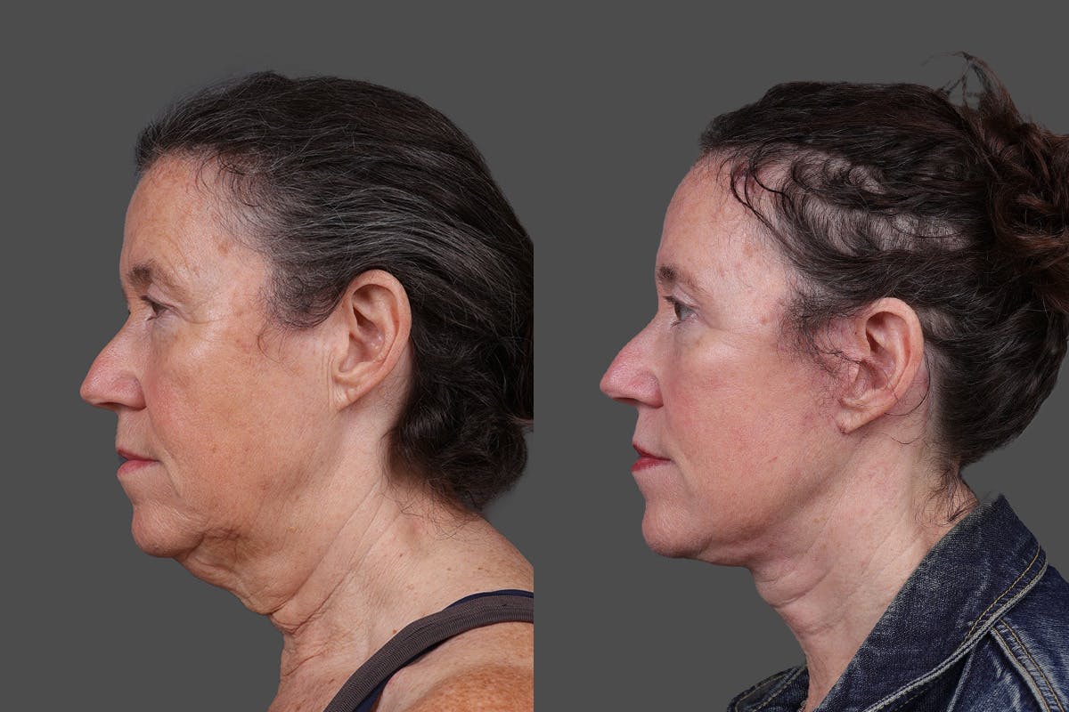 Facelift Before & After Gallery - Patient 549528 - Image 5