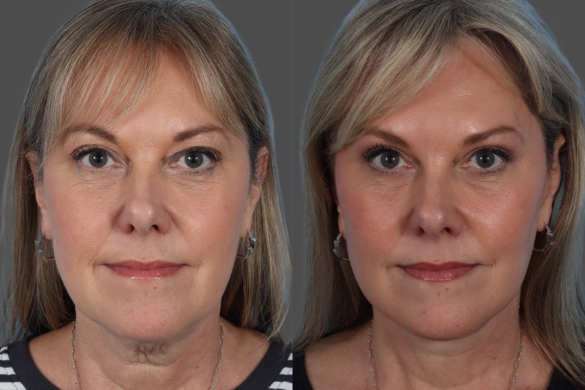 Facelift Before & After Gallery - Patient 290604 - Image 1