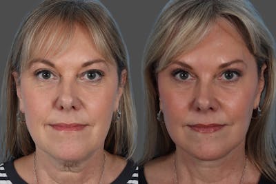 Facelift Before & After Gallery - Patient 290604 - Image 1