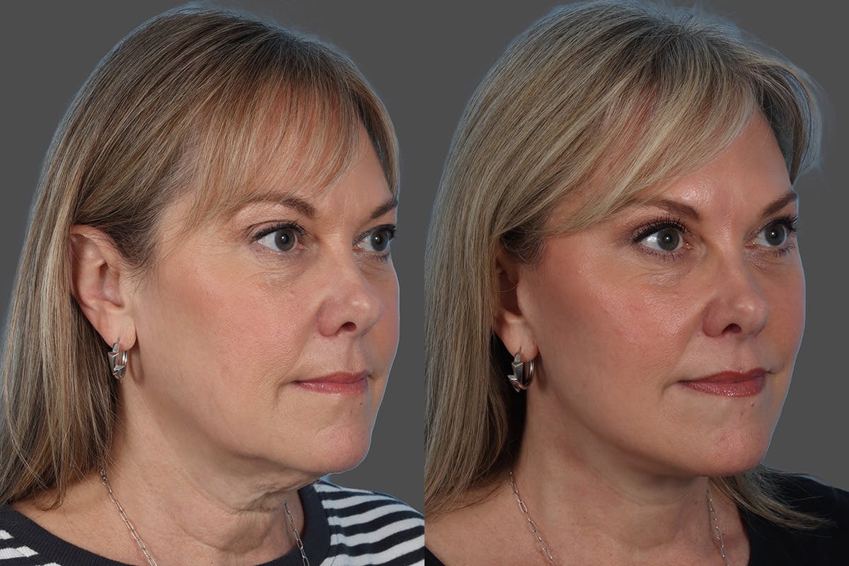 Facelift Before & After Gallery - Patient 290604 - Image 2