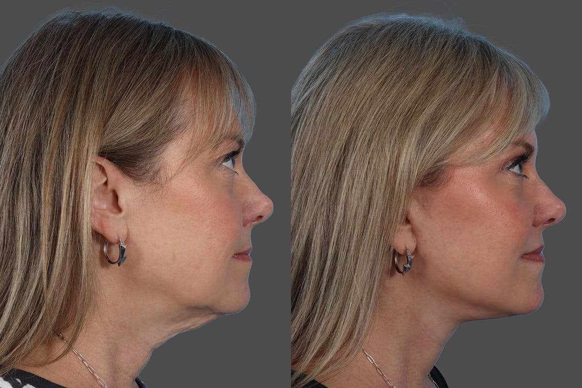 Facelift Before & After Gallery - Patient 290604 - Image 3