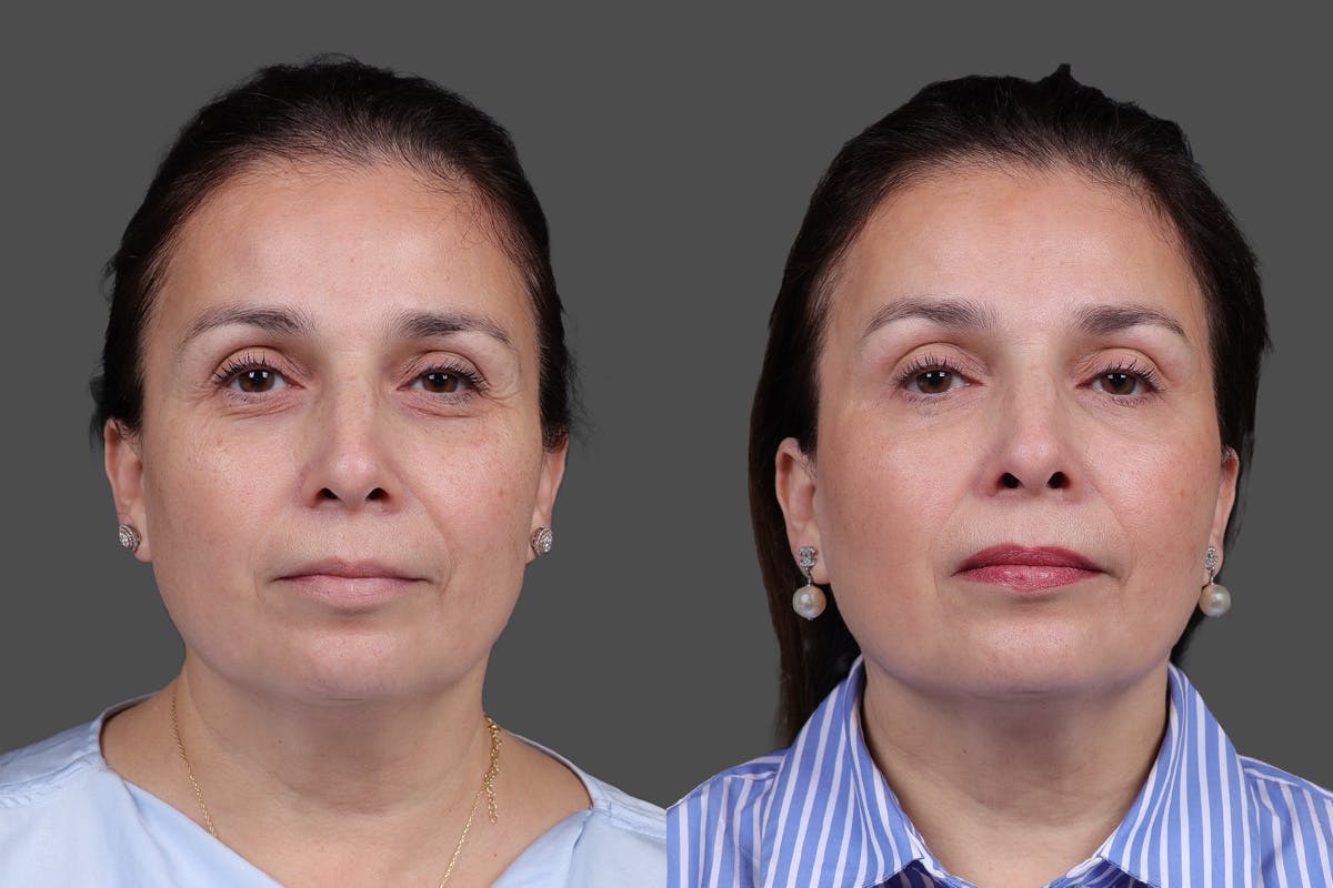 CO2 Fractional Laser Before & After Gallery - Patient 176979 - Image 1
