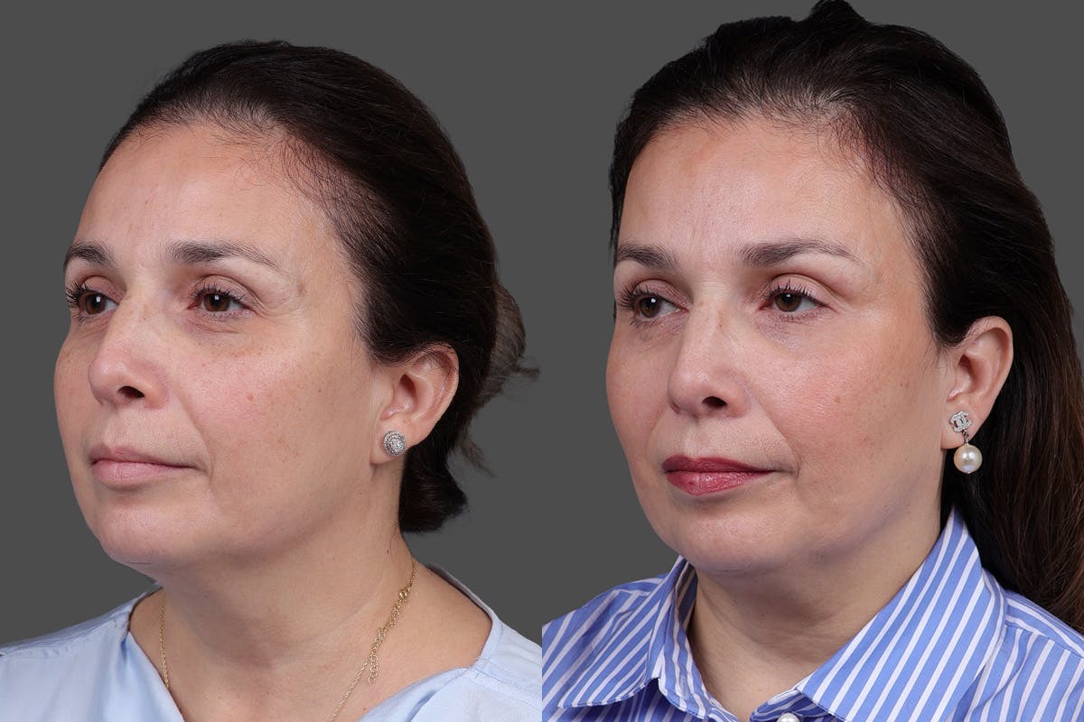 CO2 Fractional Laser Before & After Gallery - Patient 176979 - Image 4