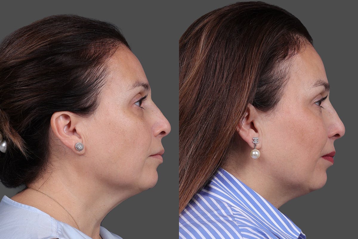 CO2 Fractional Laser Before & After Gallery - Patient 176979 - Image 3