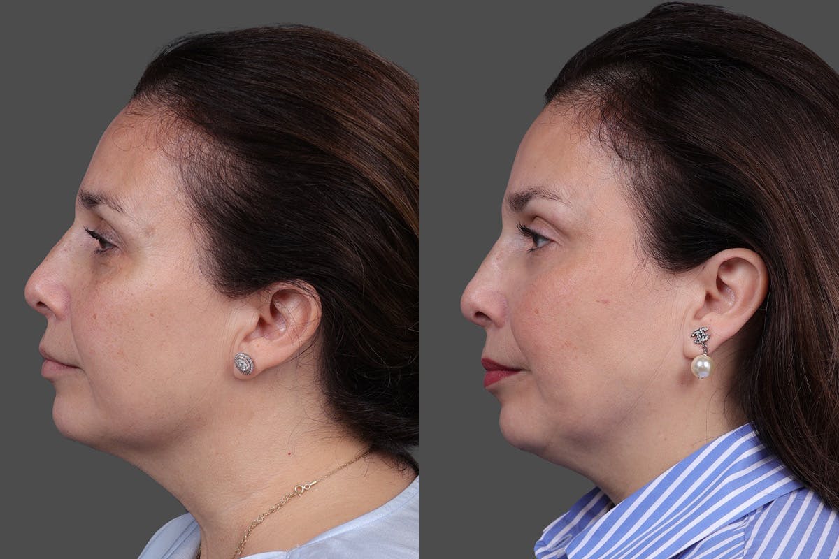CO2 Fractional Laser Before & After Gallery - Patient 176979 - Image 5