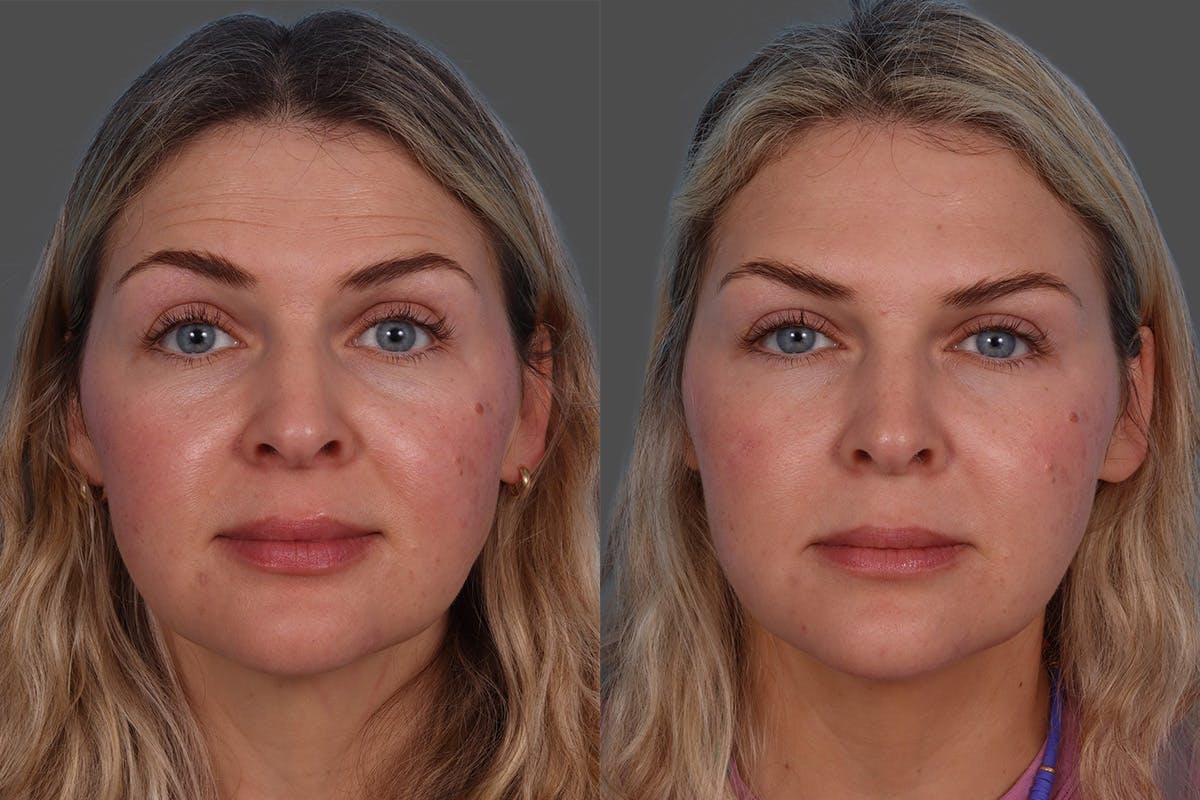 Dysport Before & After Gallery - Patient 988757 - Image 1