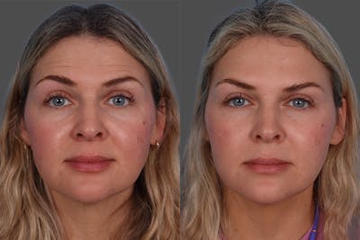 Dysport Before & After Gallery - Patient 988757 - Image 1