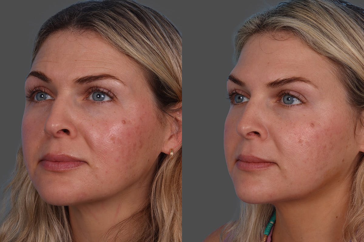 Dysport Before & After Gallery - Patient 988757 - Image 3