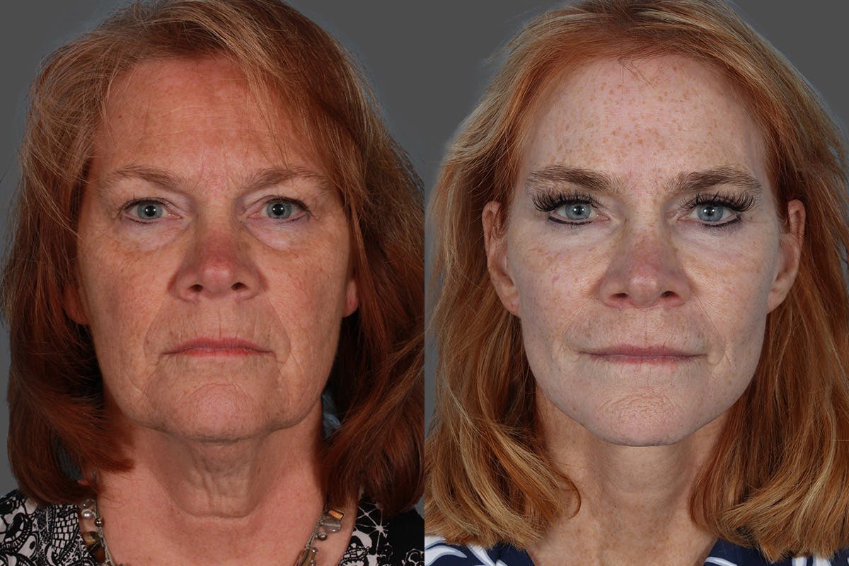 SkinVive Before & After Gallery - Patient 386484 - Image 1
