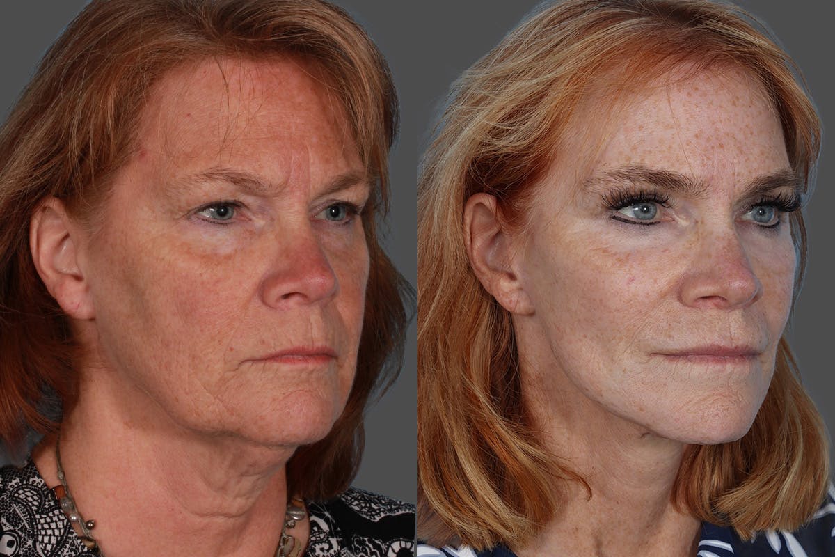 SkinVive Before & After Gallery - Patient 386484 - Image 2