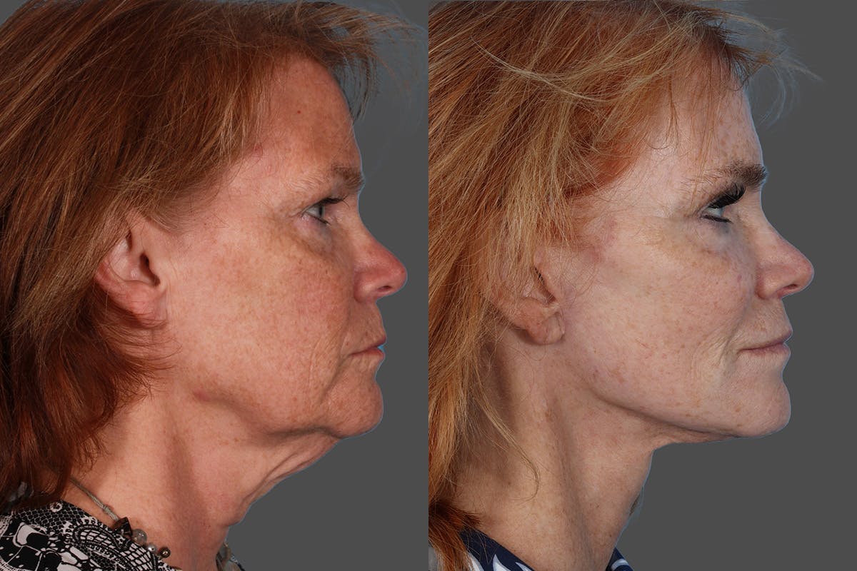 Facelift Before & After Gallery - Patient 353101 - Image 3