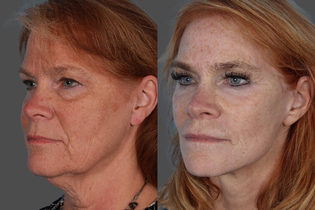 SkinVive Before & After Gallery - Patient 386484 - Image 4