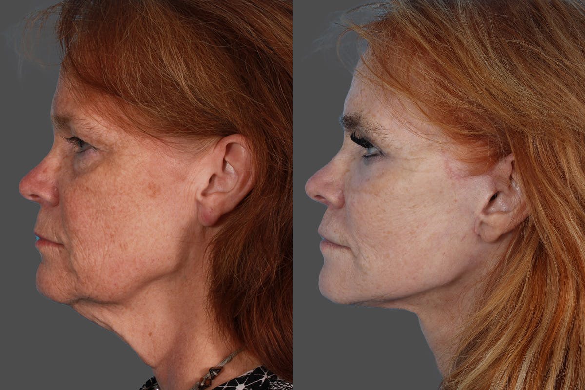 SkinVive Before & After Gallery - Patient 386484 - Image 5