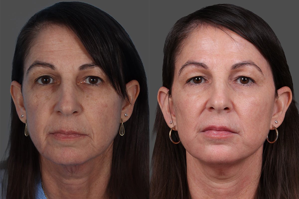 Limited Incision Facelift Before & After Gallery - Patient 131656 - Image 1
