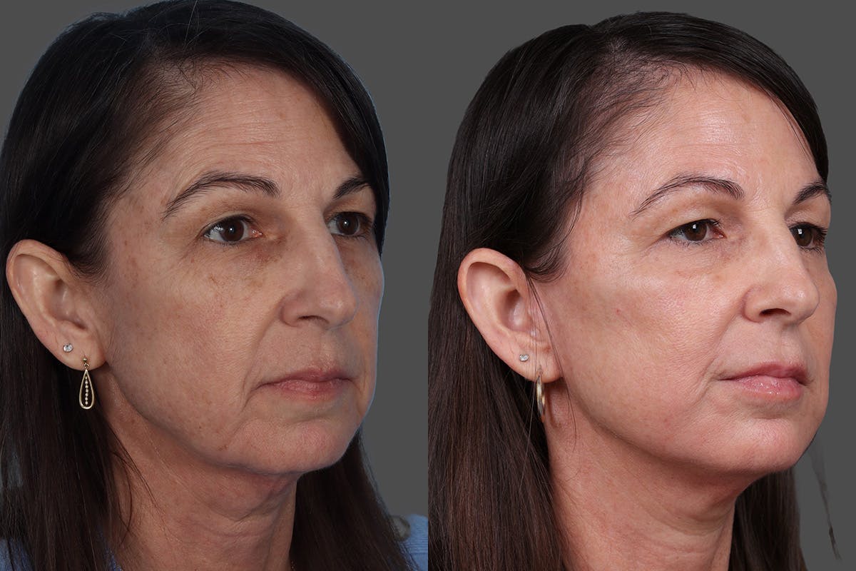 Limited Incision Facelift Before & After Gallery - Patient 131656 - Image 2