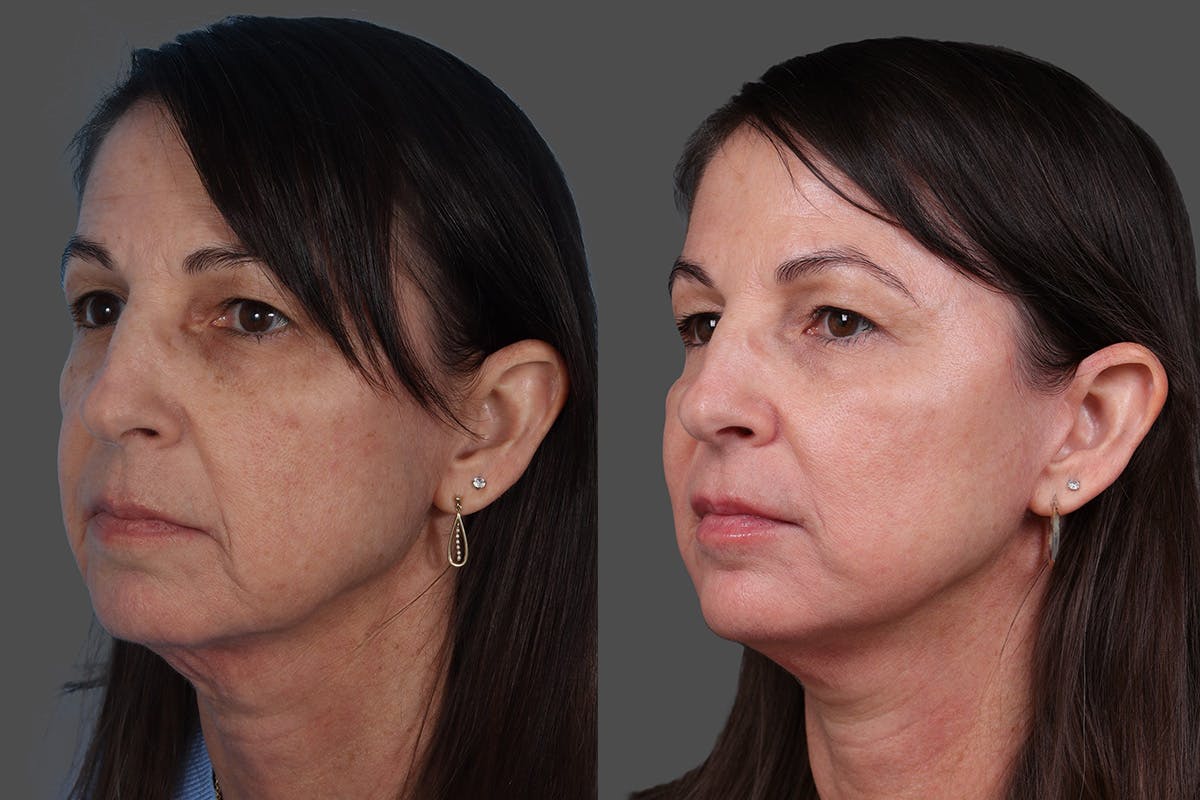 Limited Incision Facelift Before & After Gallery - Patient 131656 - Image 3