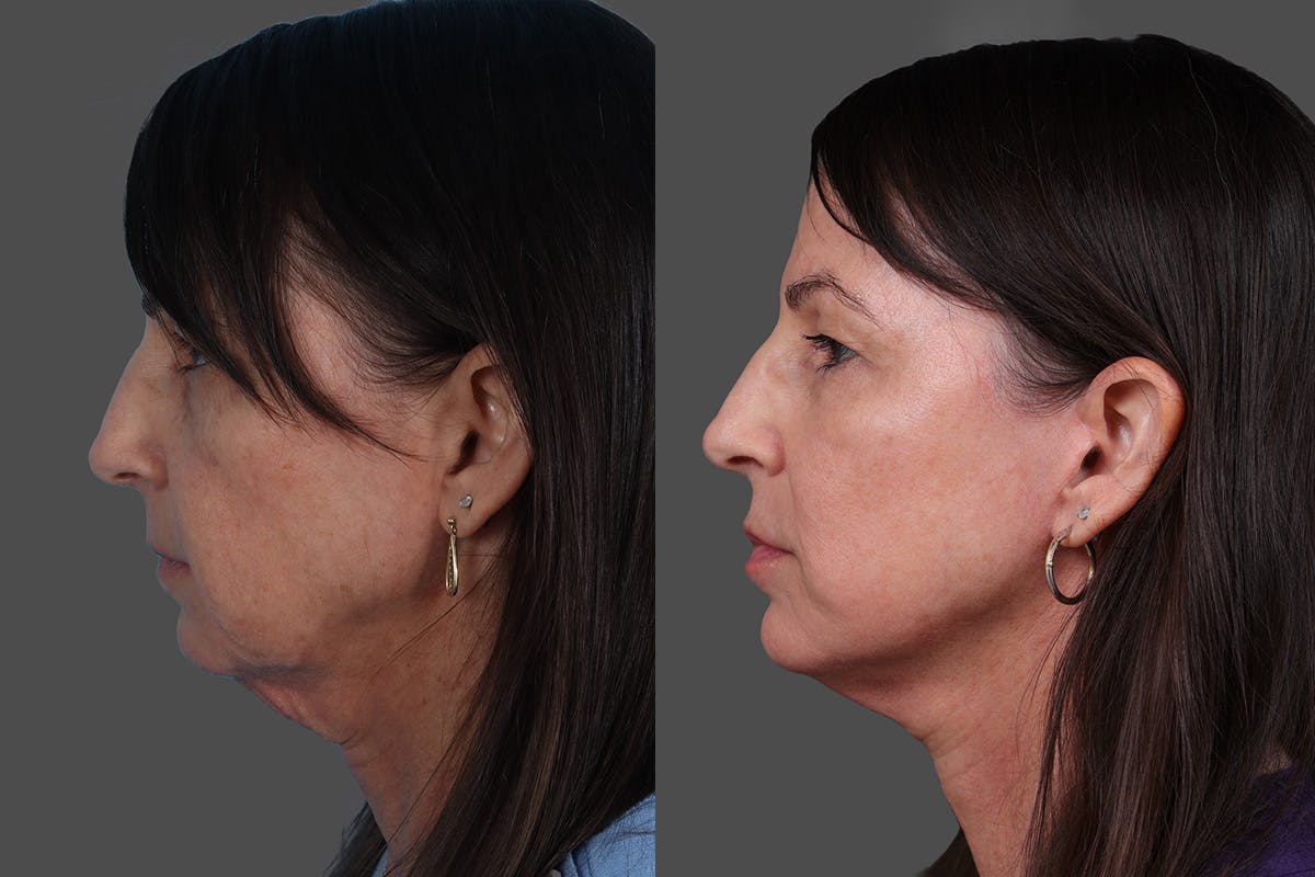 Limited Incision Facelift Before & After Gallery - Patient 131656 - Image 4