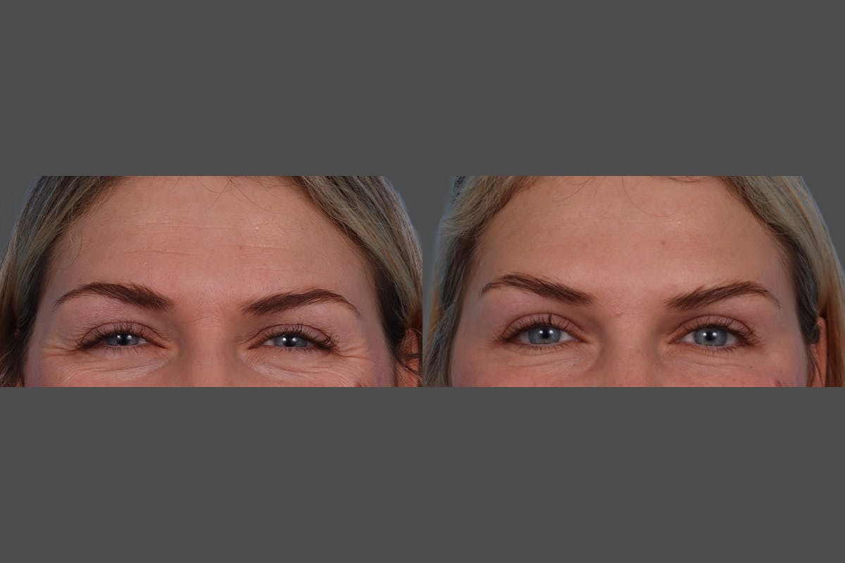 Dysport® Before & After Gallery - Patient 988757 - Image 6