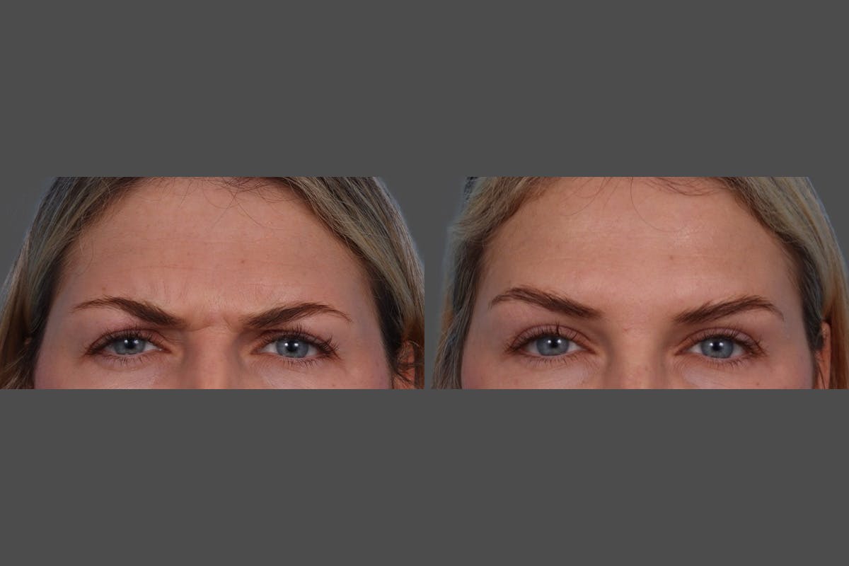 Dysport® Before & After Gallery - Patient 988757 - Image 5