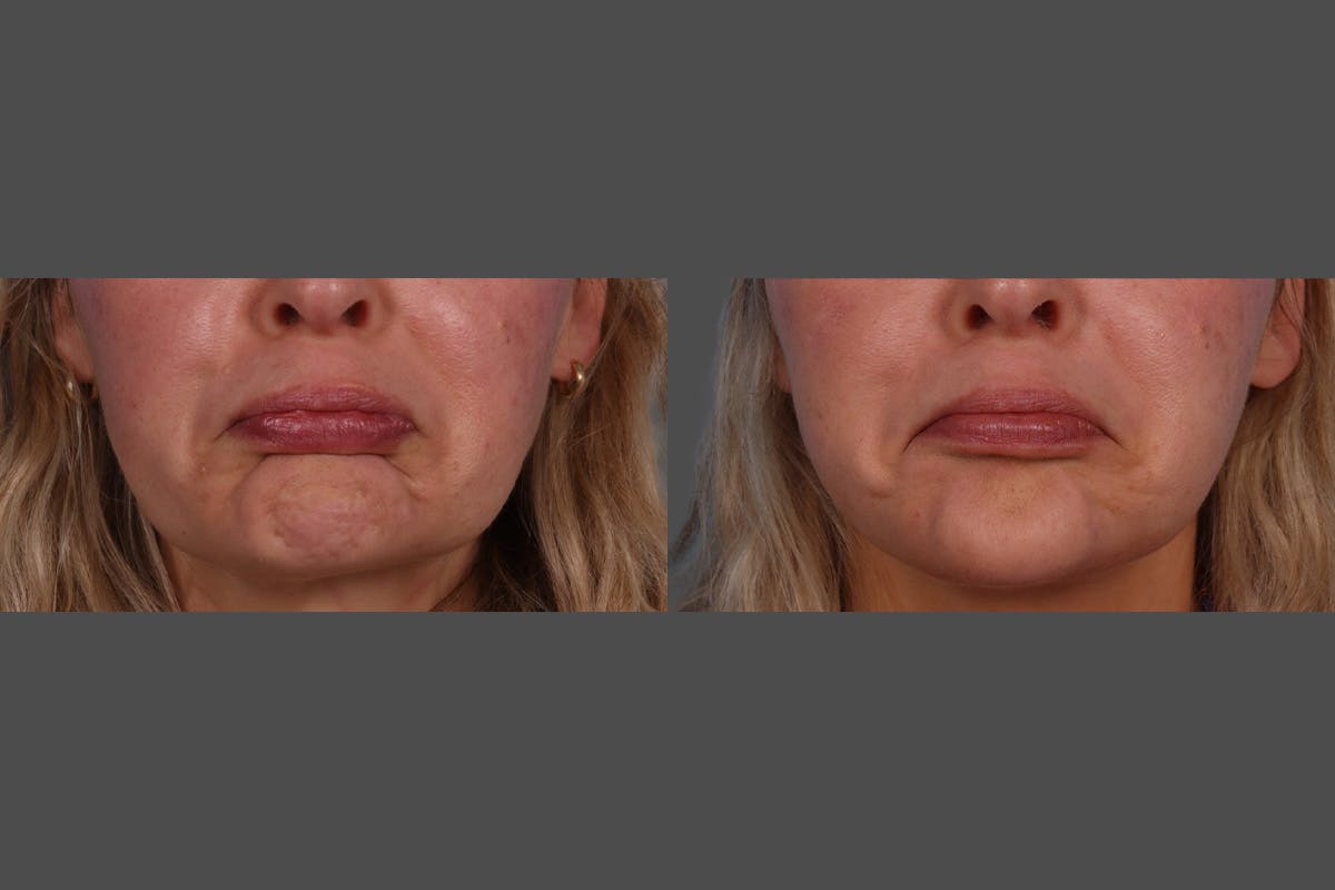 Dysport® Before & After Gallery - Patient 988757 - Image 7