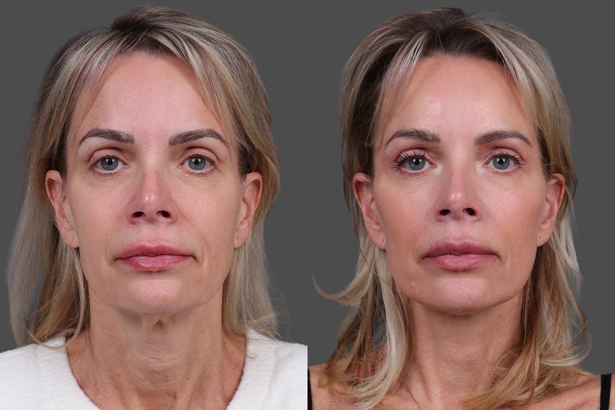 Limited Incision Facelift Before & After Gallery - Patient 194154 - Image 1