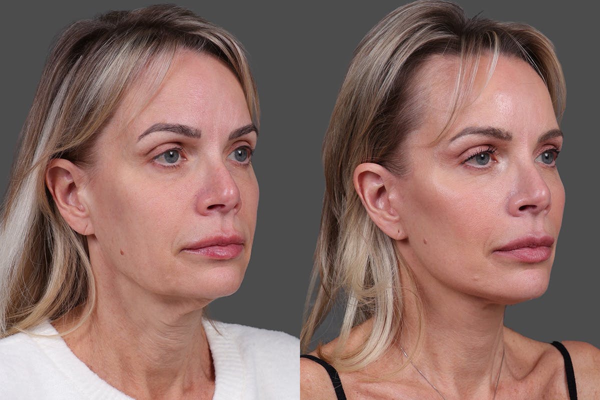Limited Incision Facelift Before & After Gallery - Patient 194154 - Image 2