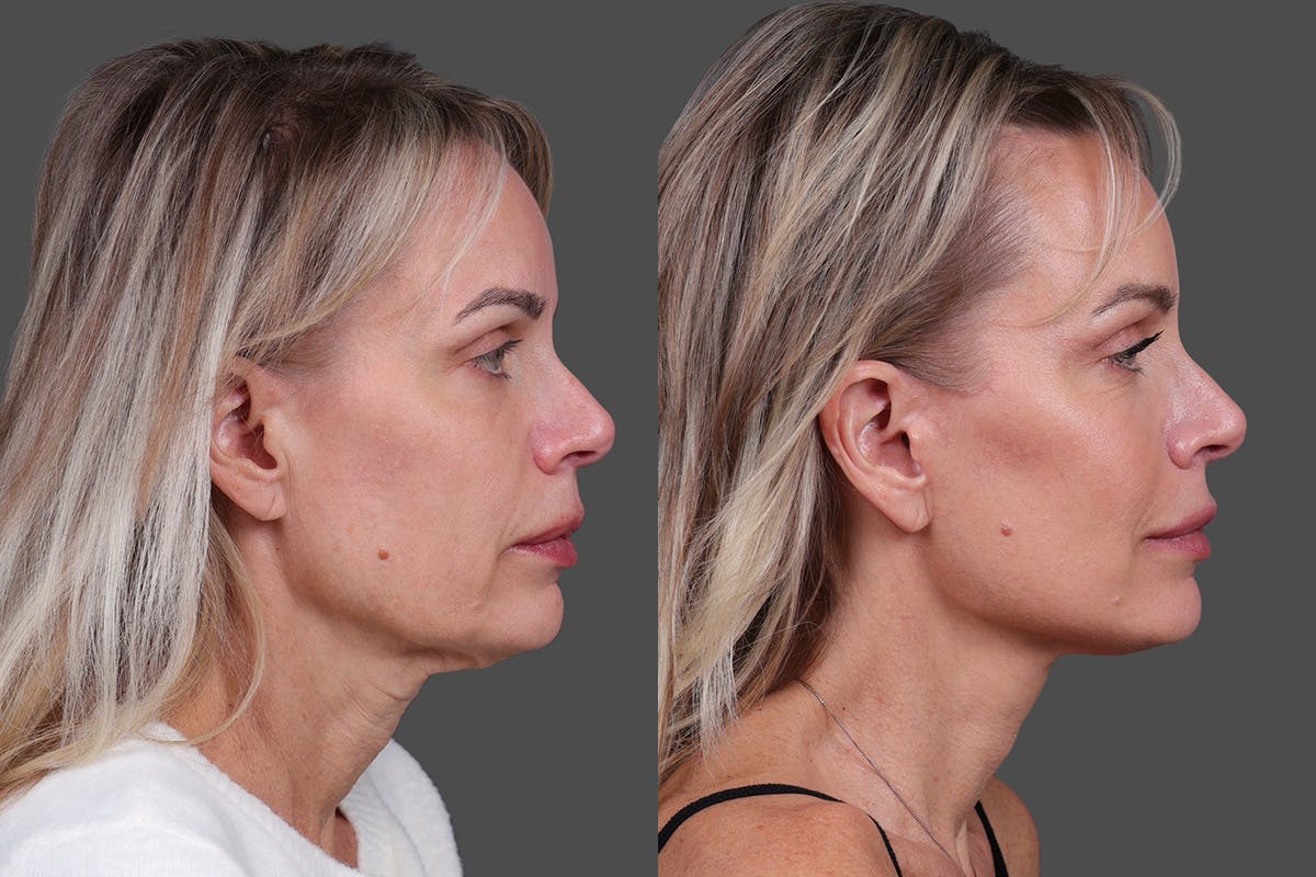 Limited Incision Facelift Before & After Gallery - Patient 194154 - Image 3