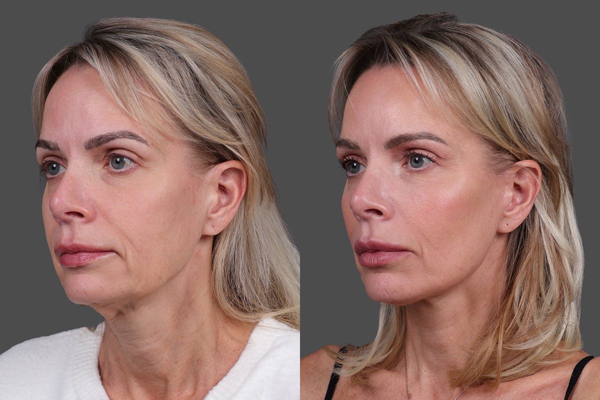 Limited Incision Facelift Before & After Gallery - Patient 194154 - Image 4