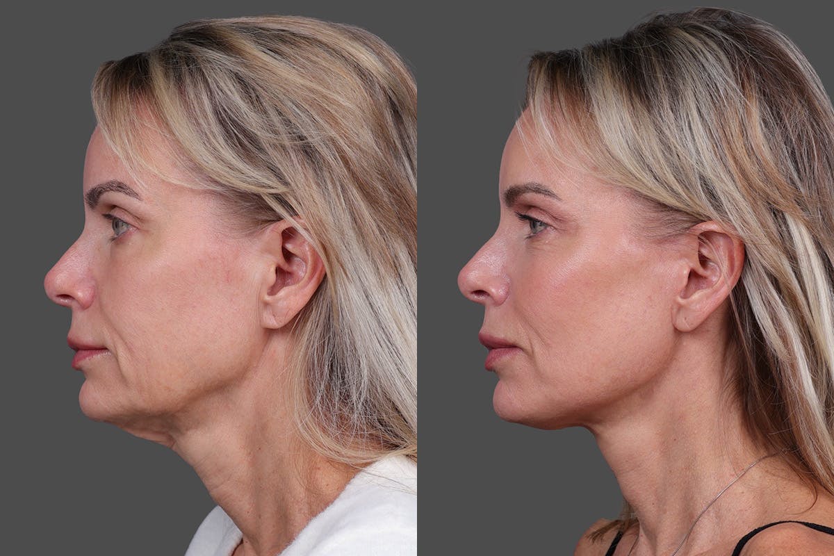 Limited Incision Facelift Before & After Gallery - Patient 194154 - Image 5