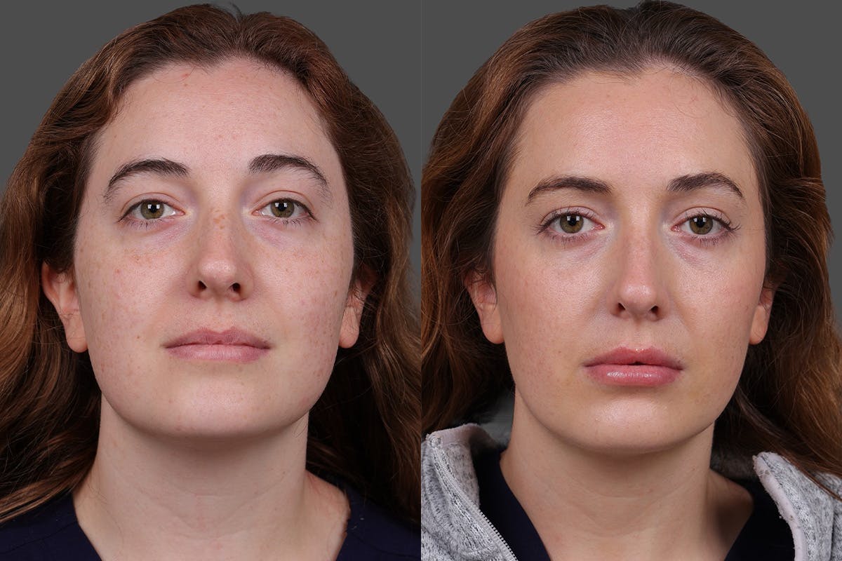 Restylane Before & After Gallery - Patient 750885 - Image 1