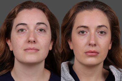 Restylane Before & After Gallery - Patient 750885 - Image 1