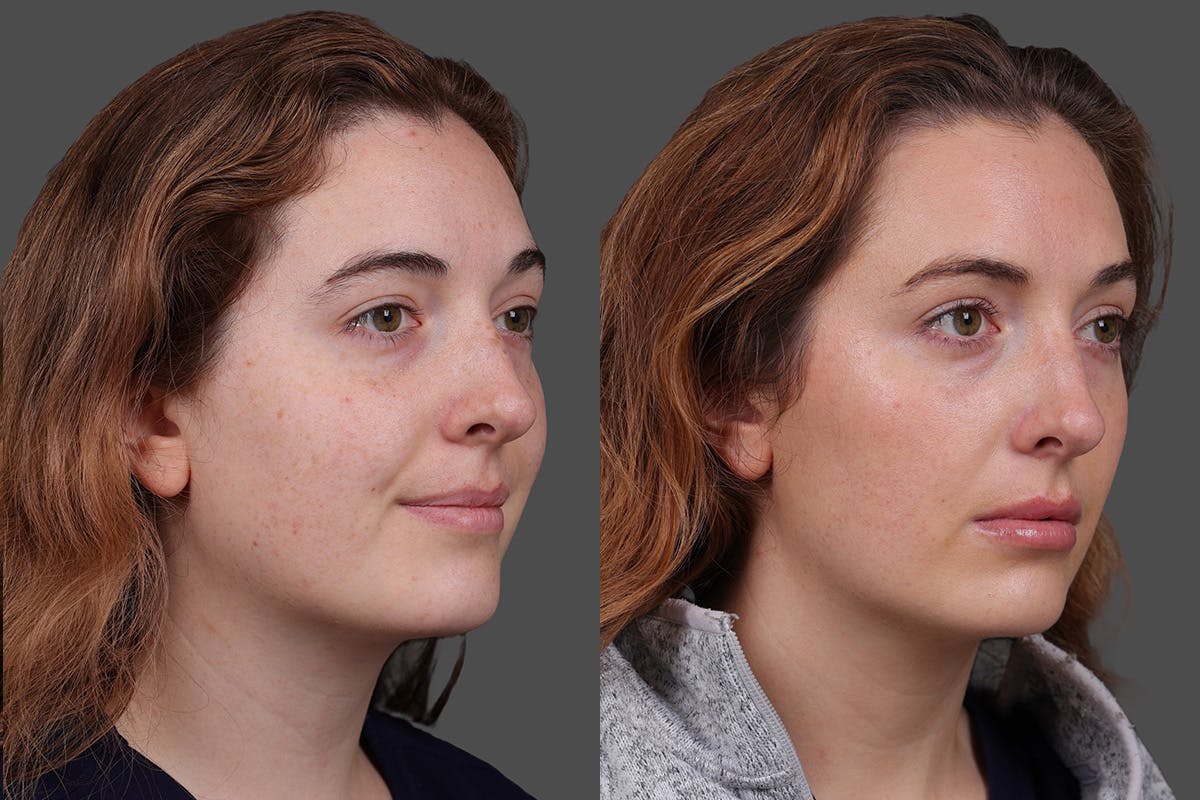 Restylane Before & After Gallery - Patient 750885 - Image 2