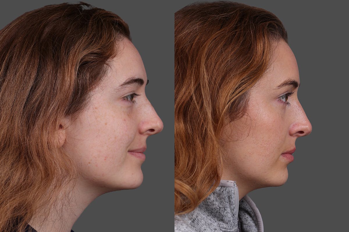 Restylane Before & After Gallery - Patient 750885 - Image 3